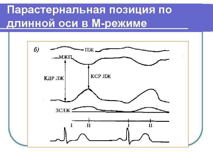 Парастернальная позиция по длинной оси в М-режиме 