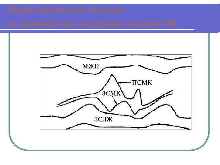 Парастернальная позиция по длинной оси на уровне створок МК 