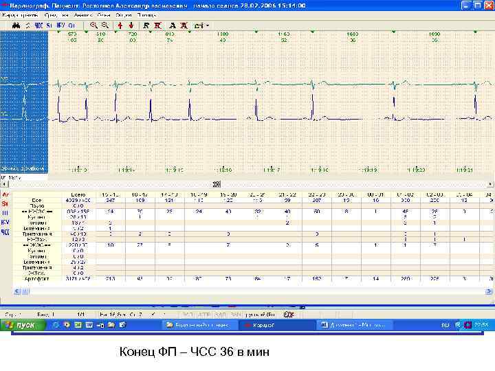 Конец ФП – ЧСС 36 в мин 