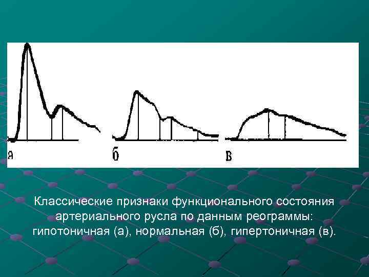 Классические признаки функционального состояния артериального русла по данным реограммы: гипотоничная (а), нормальная (б), гипертоничная