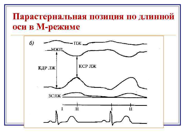 Парастернальная позиция по длинной оси в М-режиме 