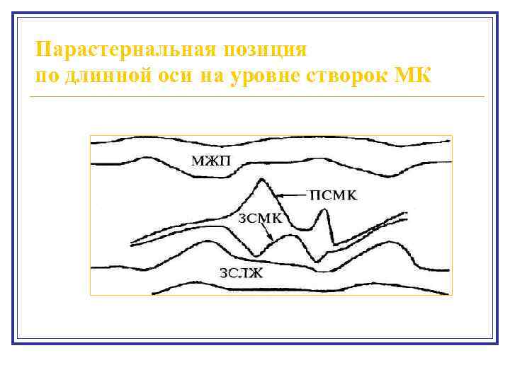 Парастернальная позиция по длинной оси на уровне створок МК 