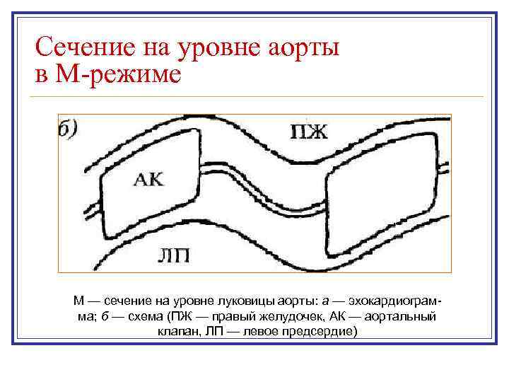 Сечение на уровне аорты в М-режиме М — сечение на уровне луковицы аорты: а
