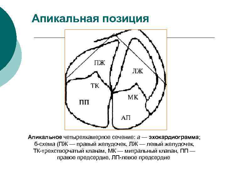 Апикальная позиция Апикальное четырехкамерпое сечение: а — эхокардиограмма; б-схема (ПЖ — правый желудочек, ЛЖ