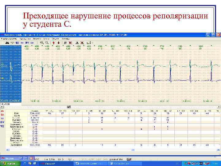 Преходящее нарушение процессов реполяризации у студента С. 