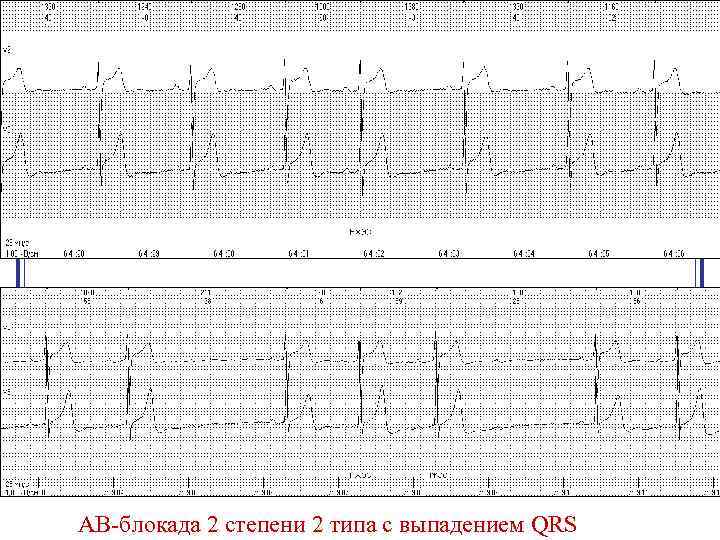 АВ-блокада 2 степени 2 типа с выпадением QRS 