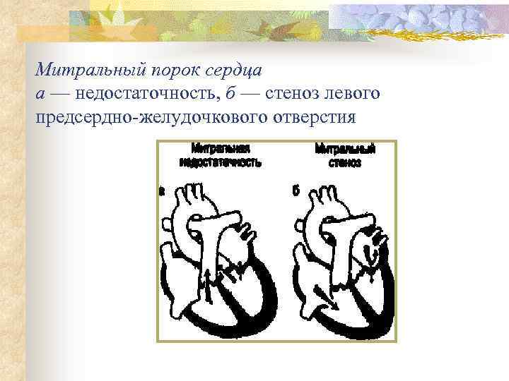 Митральный порок сердца а — недостаточность, б — стеноз левого предсердно-желудочкового отверстия 