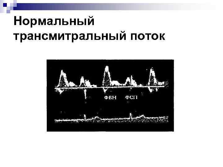Нормальный трансмитральный поток 