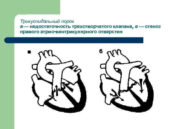 Трикуспидальный порок а — недостаточность трехстворчатого клапана, в — стеноз правого атрио-вентрикулярного отверстия 