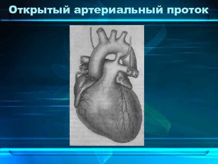 Открытый артериальный проток 