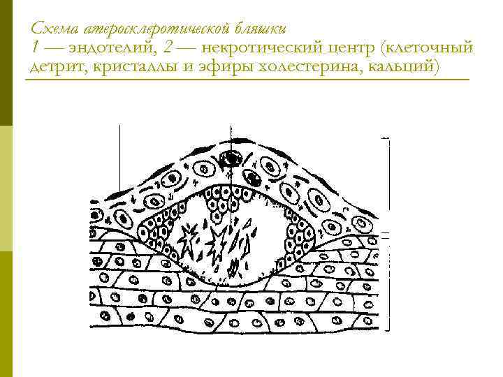 Схема атеросклеротической бляшки 1 — эндотелий, 2 — некротический центр (клеточный детрит, кристаллы и