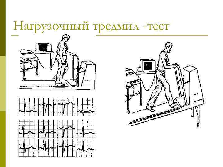 Нагрузочный тредмил -тест 