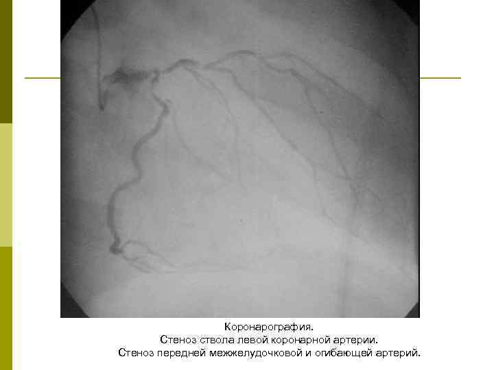 Коронарография. Стеноз ствола левой коронарной артерии. Стеноз передней межжелудочковой и огибающей артерий. 