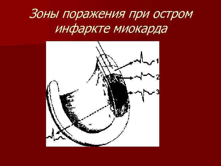 Зоны поражения при остром инфаркте миокарда 