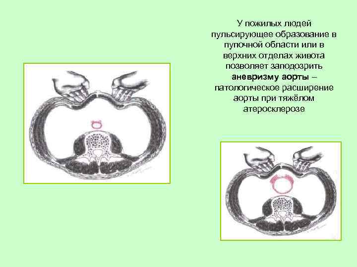 У пожилых людей пульсирующее образование в пупочной области или в верхних отделах живота позволяет