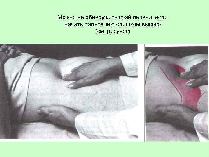 Можно не обнаружить край печени, если начать пальпацию слишком высоко (см. рисунок) 