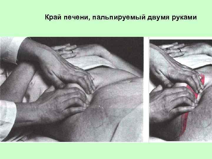 Край печени, пальпируемый двумя руками 