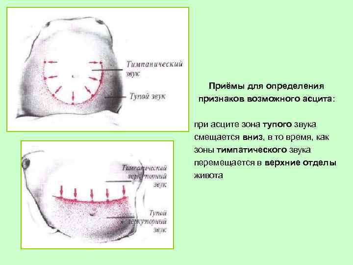 Приёмы для определения признаков возможного асцита: при асците зона тупого звука смещается вниз, в