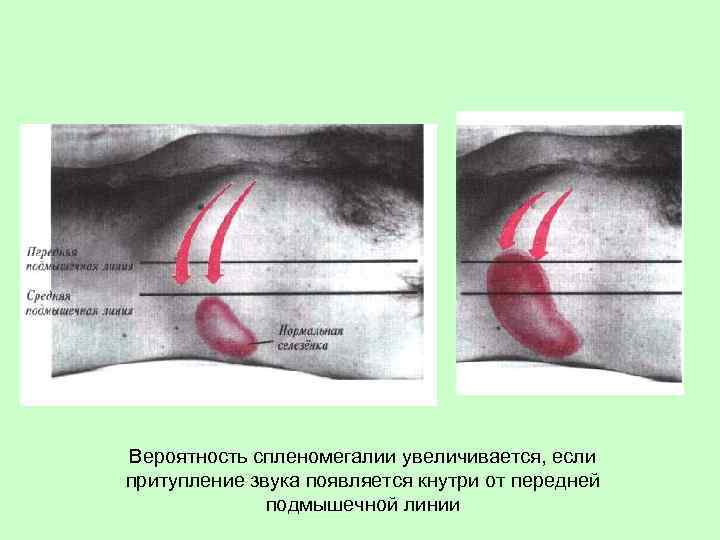 Вероятность спленомегалии увеличивается, если притупление звука появляется кнутри от передней подмышечной линии 