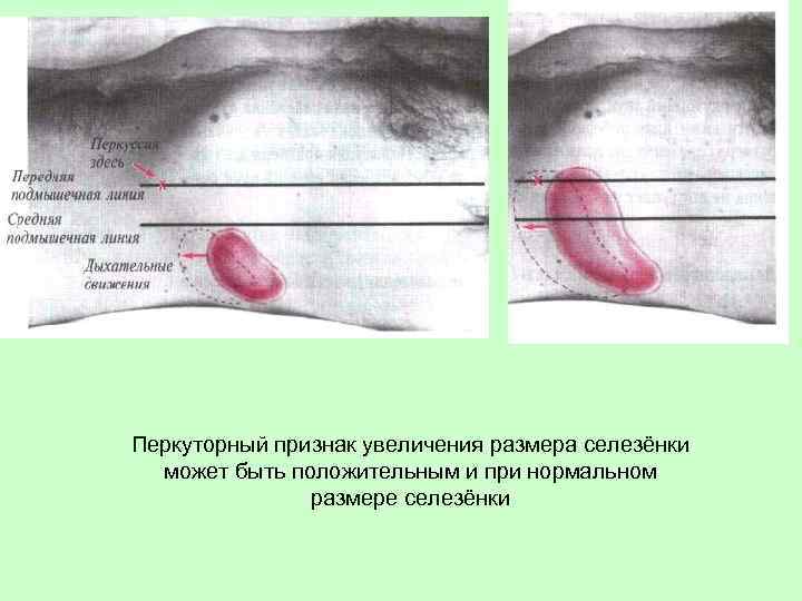 Перкуторный признак увеличения размера селезёнки может быть положительным и при нормальном размере селезёнки 