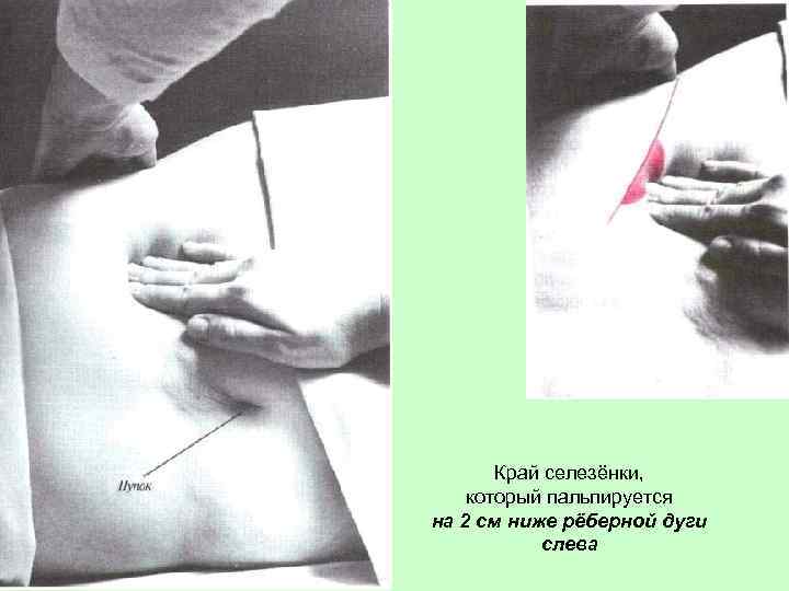 Край селезёнки, который пальпируется на 2 см ниже рёберной дуги слева 