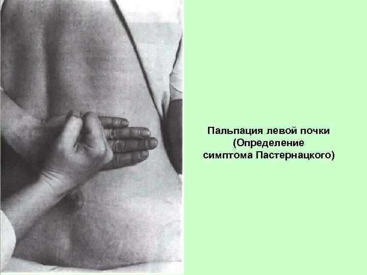 Пальпация левой почки (Определение симптома Пастернацкого) 