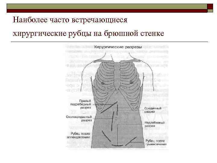 Наиболее часто встречающиеся хирургические рубцы на брюшной стенке 