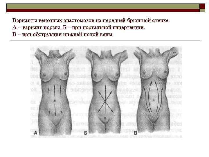 Варианты венозных анастомозов на передней брюшной стенке А – вариант нормы. Б – при