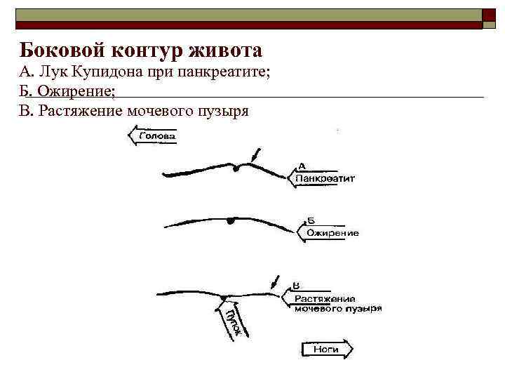 Боковой контур живота А. Лук Купидона при панкреатите; Б. Ожирение; В. Растяжение мочевого пузыря