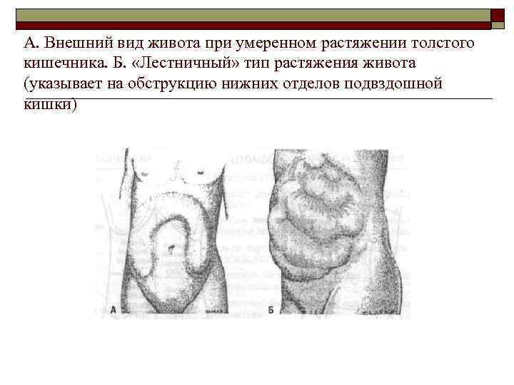 А. Внешний вид живота при умеренном растяжении толстого кишечника. Б. «Лестничный» тип растяжения живота