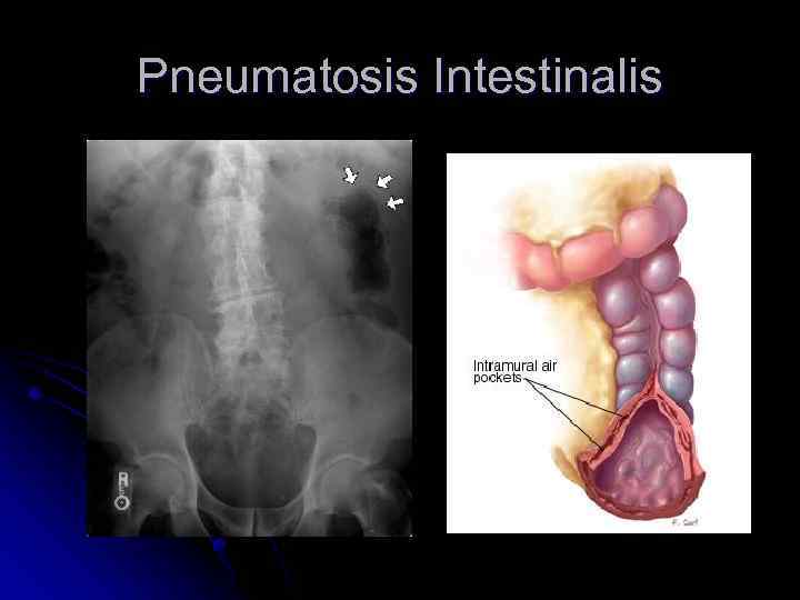 Pneumatosis Intestinalis 