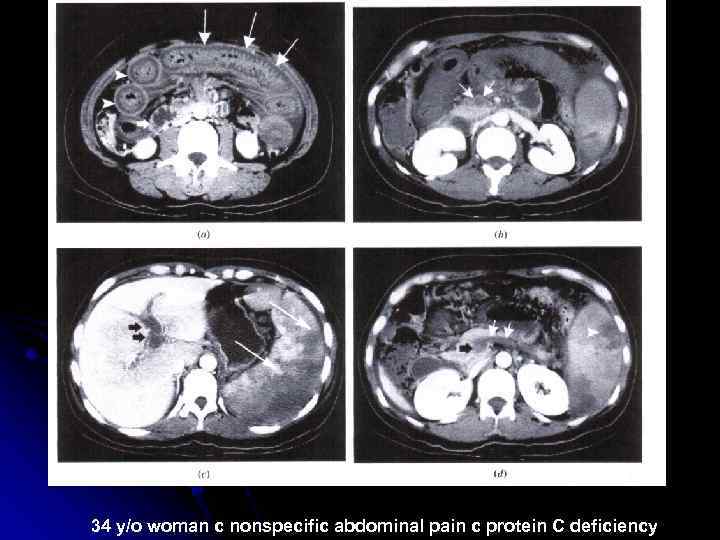 34 y/o woman c nonspecific abdominal pain c protein C deficiency 