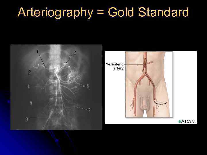Arteriography = Gold Standard 