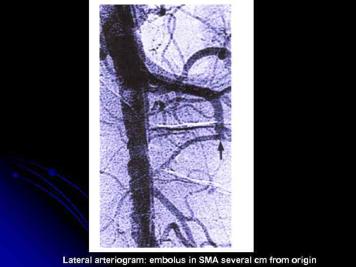 Lateral arteriogram: embolus in SMA several cm from origin 