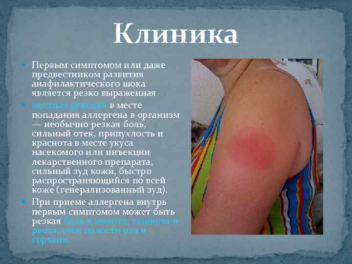 Клиника Первым симптомом или даже предвестником развития анафилактического шока является резко выраженная местная реакция