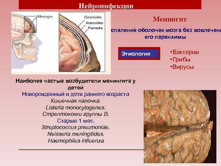 Нейроинфекции Менингит воспаление оболочек мозга без вовлечени его паренхимы Этиология Наиболее частые возбудители менингита