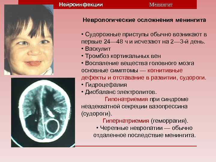 Нейроинфекции Менингит Неврологические осложнения менингита • Судорожные приступы обычно возникают в первые 24— 48