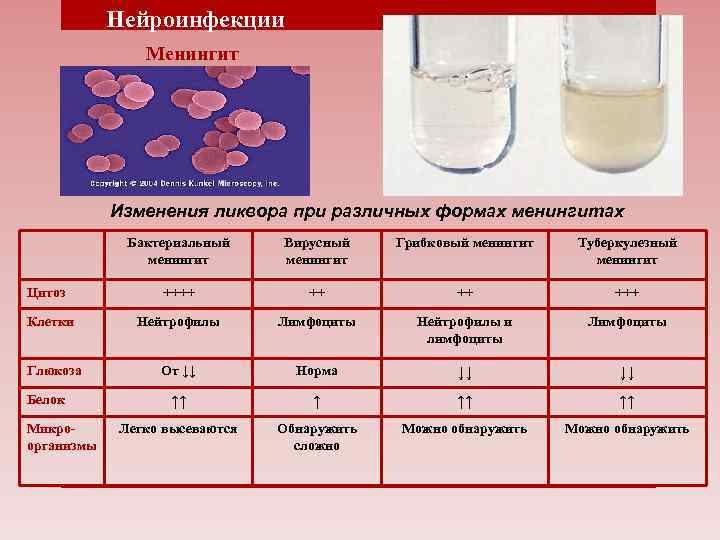 Нейроинфекции Менингит Изменения ликвора при различных формах менингитах Бактериальный менингит Вирусный менингит Грибковый менингит