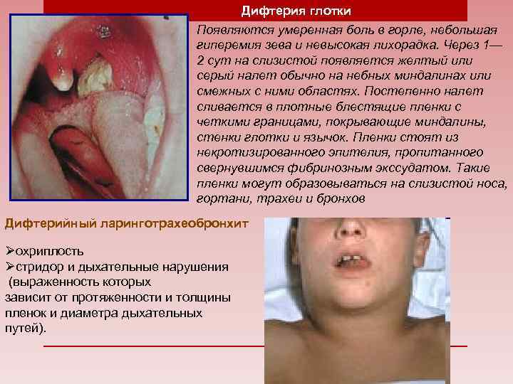 Дифтерия глотки Появляются умеренная боль в горле, небольшая гиперемия зева и невысокая лихорадка. Через