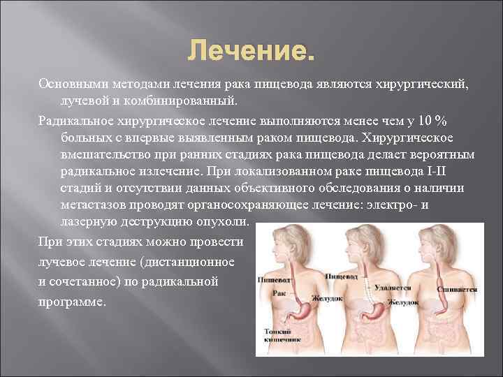 Лечение. Основными методами лечения рака пищевода являются хирургический, лучевой и комбинированный. Радикальное хирургическое лечение