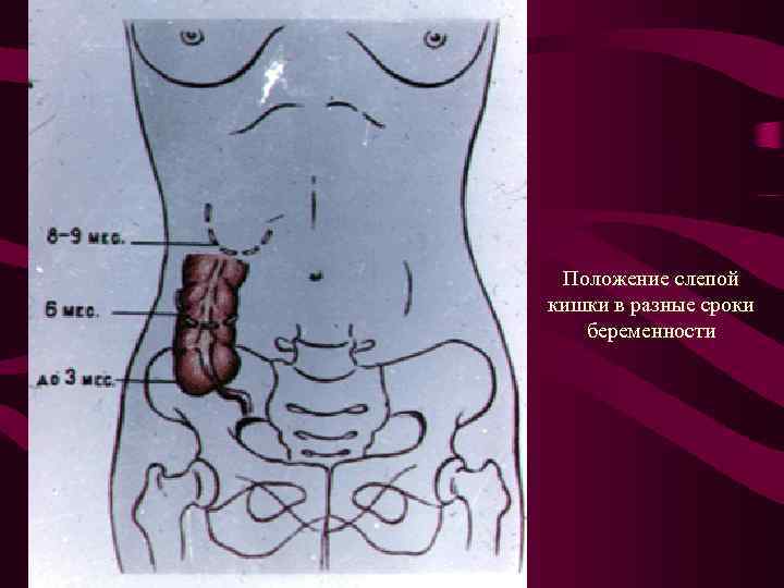 Положение слепой кишки в разные сроки беременности 