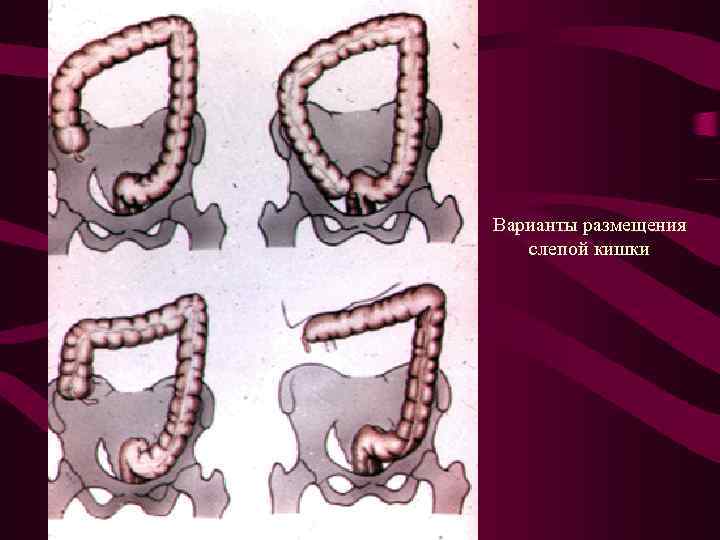 Варианты размещения слепой кишки 