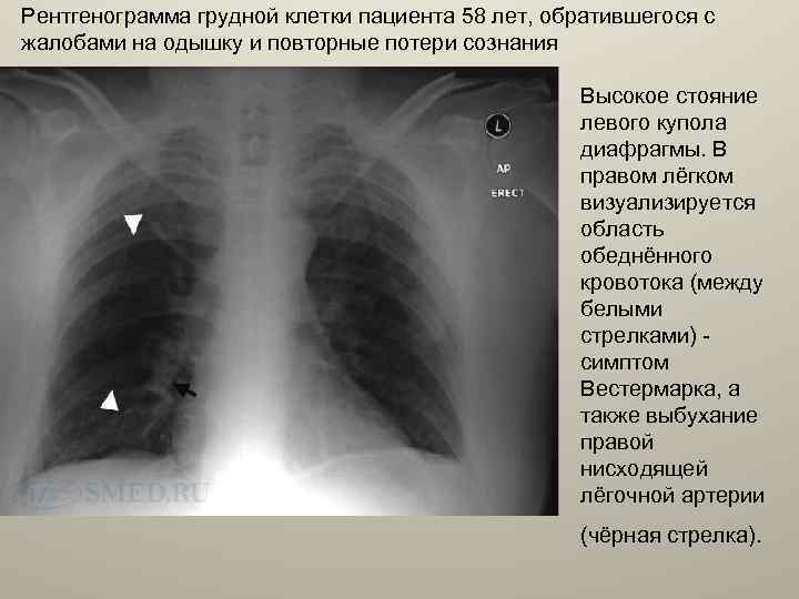 Рентгенограмма грудной клетки пациента 58 лет, обратившегося с жалобами на одышку и повторные потери