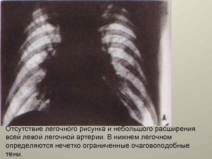 Отсутствие легочного рисунка и небольшого расширения всей левой легочной артерии. В нижнем легочном определяются