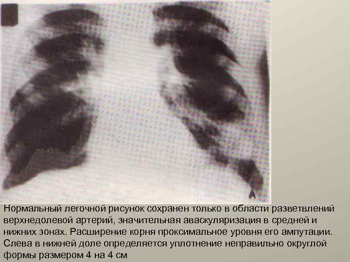 Нормальный легочной рисунок сохранен только в области разветвлений верхнедолевой артерий, значительная аваскуляризация в средней