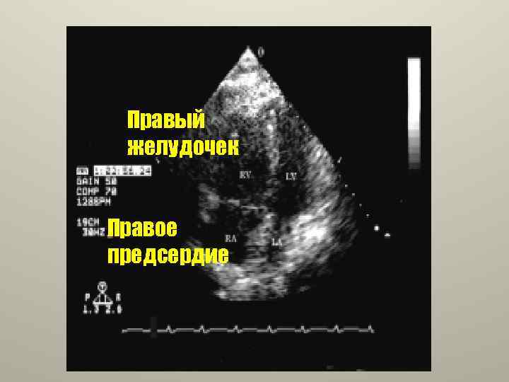 Правый желудочек Правое предсердие 