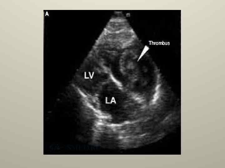 Тромбоз ушка предсердия. Тромбоэмболия легочной артерии на УЗИ. Тромбоэмболия легочной артерии на ЭХОКГ. ЭХОКГ тромб в легочной артерии. ЭХОКГ при тромбоэмболии легочной артерии.