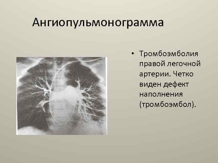 Ангиопульмонограмма • Тромбоэмболия правой легочной артерии. Четко виден дефект наполнения (тромбоэмбол). 