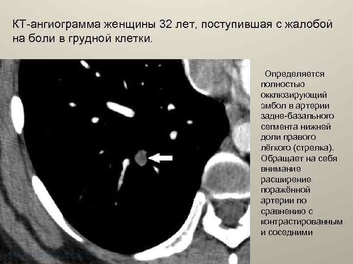 КТ-ангиограмма женщины 32 лет, поступившая с жалобой на боли в грудной клетки. Определяется полностью