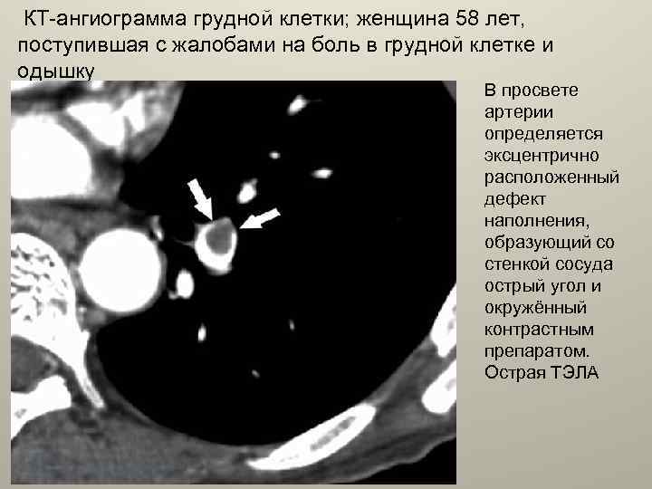  КТ-ангиограмма грудной клетки; женщина 58 лет, поступившая с жалобами на боль в грудной